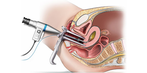 Uro Gynecology Treatment In Kolathur